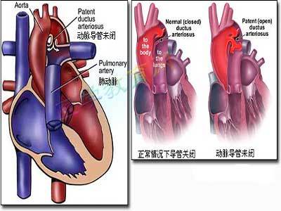 心血管造影有什么副作用?这个手术危险大吗?