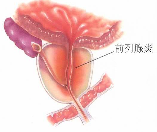 前列腺炎的治疗费用是多少