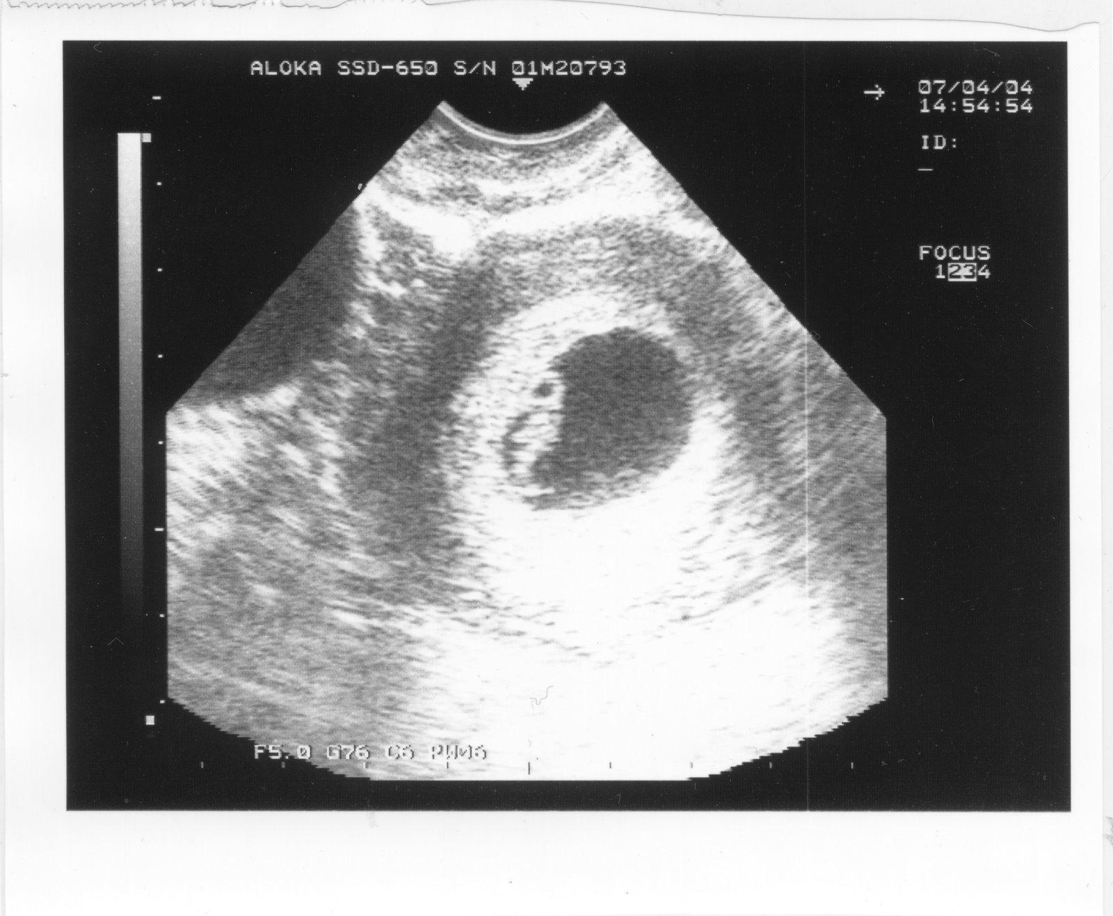 这过程医学上称为受精卵的植入或着床