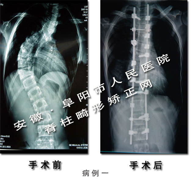 >> 文章内容 >> 脊柱外伤应用ct和mri临床诊断对比分析  脊椎l5压缩性