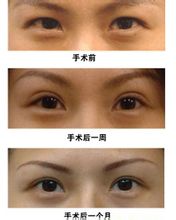 皮手术已经是临床中使用最多的一种双眼皮整形